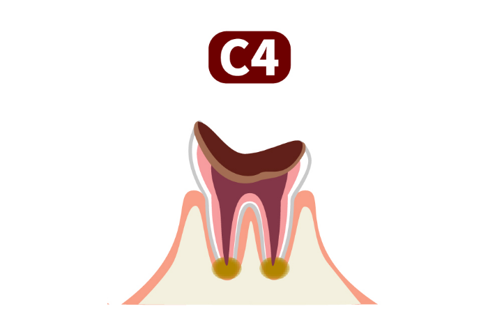 歯根に達した虫歯
